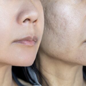 Skin Resurfacing (Scar Management)