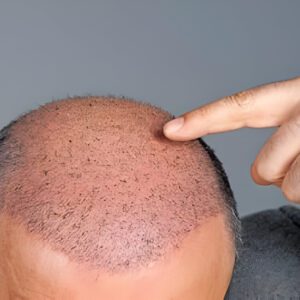 Hair Restoration Treatment
