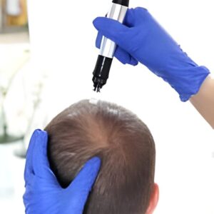 Hair Nourishment (Mesotherapy)