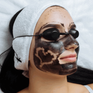 Carbon Laser peel