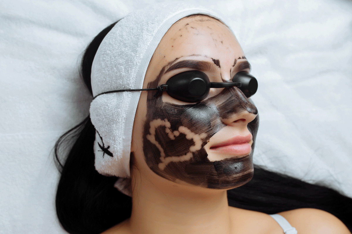 Carbon Laser peel