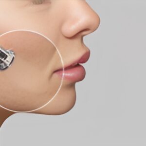 Microdermabrasion (Skin Polishing)