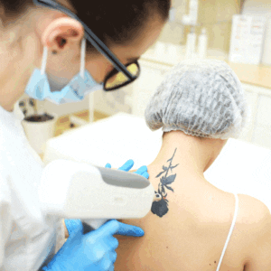 Tattoo-Removal